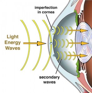 Standard Laser Vision Treatment